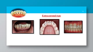 31
Extra-coronal type
 