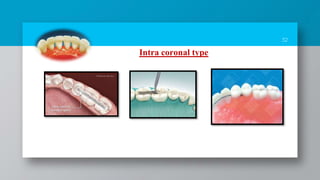 32
Intra coronal type
 