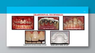 45
TRADITIONAL TECHNIQUES
TITANIUM TRAUMA SPLINT(TTS) CAST METAL SPLINT COMPOSITE WIRE SPLINT
COMPOSITE INTERLOCKING SPLINT BAND-ARCH WIRE SPLINT
 