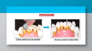 55
PROCEDURE
Clean surfaces to be bonded Measure required length of fibre
 