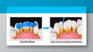 56
Etch all surfaces Apply bond according to instructions
 
