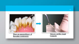57
Place an uncured layer of
flowable COMPOSITE
Take pre- cut fibre length
Composite
 