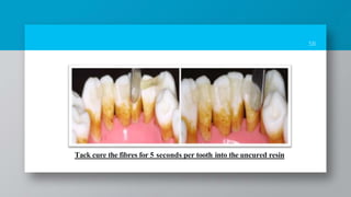 58
Tack cure the fibres for 5 seconds per tooth into the uncured resin
 