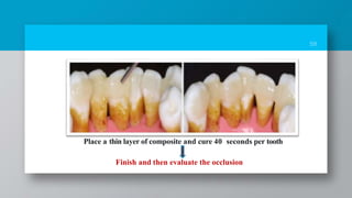 59
Place a thin layer of composite and cure 40 seconds per tooth
Finish and then evaluate the occlusion
 