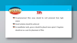 60
TIPS
Un-polymerised fibre areas should be well protected from light
source
Good isolation should be achieved
In mandibular teeth, groove should be placed more apical. Cingulum
should act as a seat for placement of fibre
 