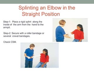 Splinting in sports | PPTX