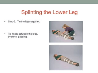 Splinting in sports | PPTX