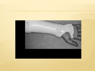 Splinting | PPTX
