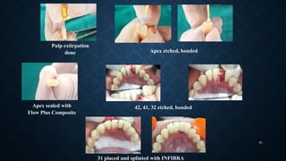 Splinting in Periodontics | PPTX