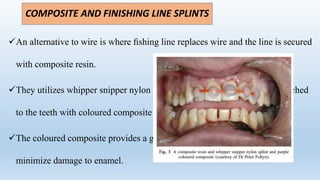 COMPOSITE AND FINISHING LINE SPLINTS
An alternative to wire is where ﬁshing line replaces wire and the line is secured
with composite resin.
They utilizes whipper snipper nylon purchased from a hardware store attached
to the teeth with coloured composite resin (Ultradent; ﬂowable purple.
The coloured composite provides a guide for the removal of the splint to
minimize damage to enamel.
 