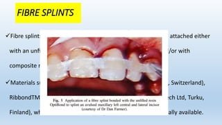 FIBRE SPLINTS
Fibre splints use a polyethylene or Kevlar ﬁbre mesh and are attached either
with an unﬁlled resin such as OptibondTM FL (Kerr, USA) and/or with
composite resin.
Materials such as Fiber-Splint (Polydentia SA Mezzovico-Vira, Switzerland),
RibbondTM (Ribbond Inc., Seattle, USA) or EverStick (Stick Tech Ltd, Turku,
Finland), which is a silinated E-type glass ﬁbre, are commercially available.
 