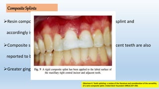 CompositeSplints
Resin composite applied to the surfaces of teeth is a rigid splint and
accordingly is not recommended in the IADT guidelines.
Composite splints that are bonded interproximally to adjacent teeth are also
reported to be prone to fracture.
Greater gingival irritation.
Oikarinen K. Tooth splinting: a review of the literature and consideration of the versatility
of a wire-composite splint. Endod Dent Traumatol 1990;6:237–250.
 