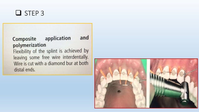 Splinting of traumatized teeth | PPTX