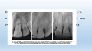 • It has been shown that splinted and non‐splinted teeth did not differ in
outcome of treatment, i.e. whether the healing takes place by hard tissue
union, inter‐position of connective tissue and/or bone or no healing.
 
