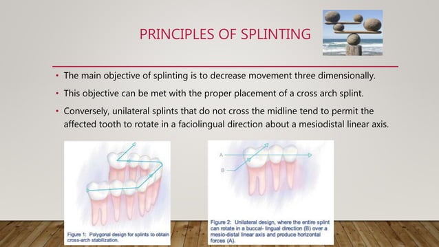 Splinting of traumatized teeth | PPTX