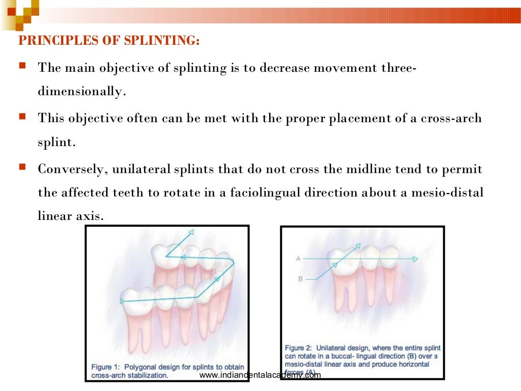 Splinting part i /certified fixed orthodontic courses by Indian denta…