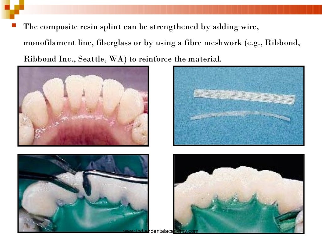 Splinting part i /certified fixed orthodontic courses by Indian denta…