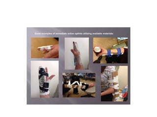 Splinting Methods SPLINTING TECHNIQUES.pptx orthopaedics ppt | PPTX