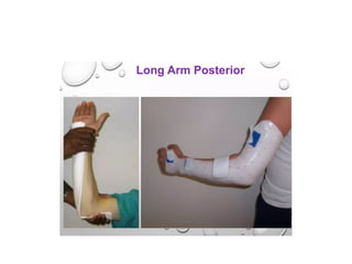 SPLINTING TECHNIQUES.pptx orthopaedics ppt | PPTX