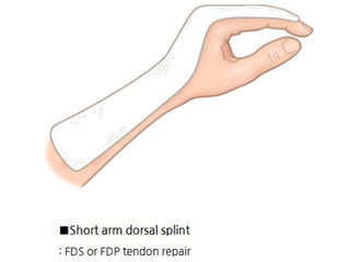 Different Splinting Techniques of Fractures.pptx