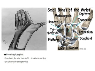 Splinting Skeleton Different Splinting Techniques of Fractures.pptx