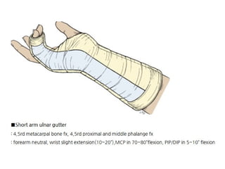 Splinting Skeleton Different Splinting Techniques of Fractures.pptx