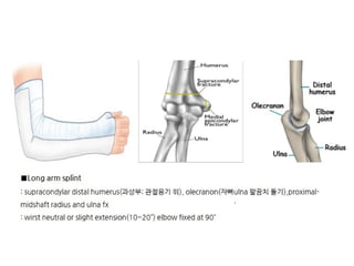 Different Splinting Techniques of Fractures.pptx