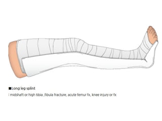 Splinting Skeleton Different Splinting Techniques of Fractures.pptx