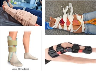 Splinting Humor Different Splinting Techniques of Fractures.pptx