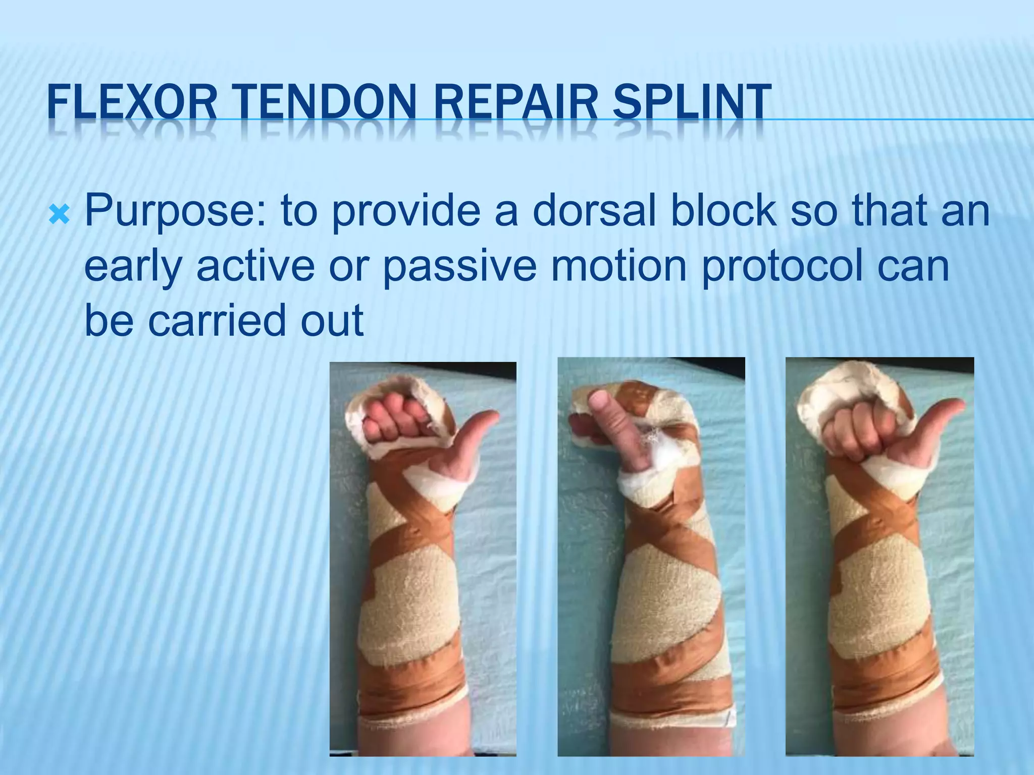 Splinting when you have no therapists | PPTX