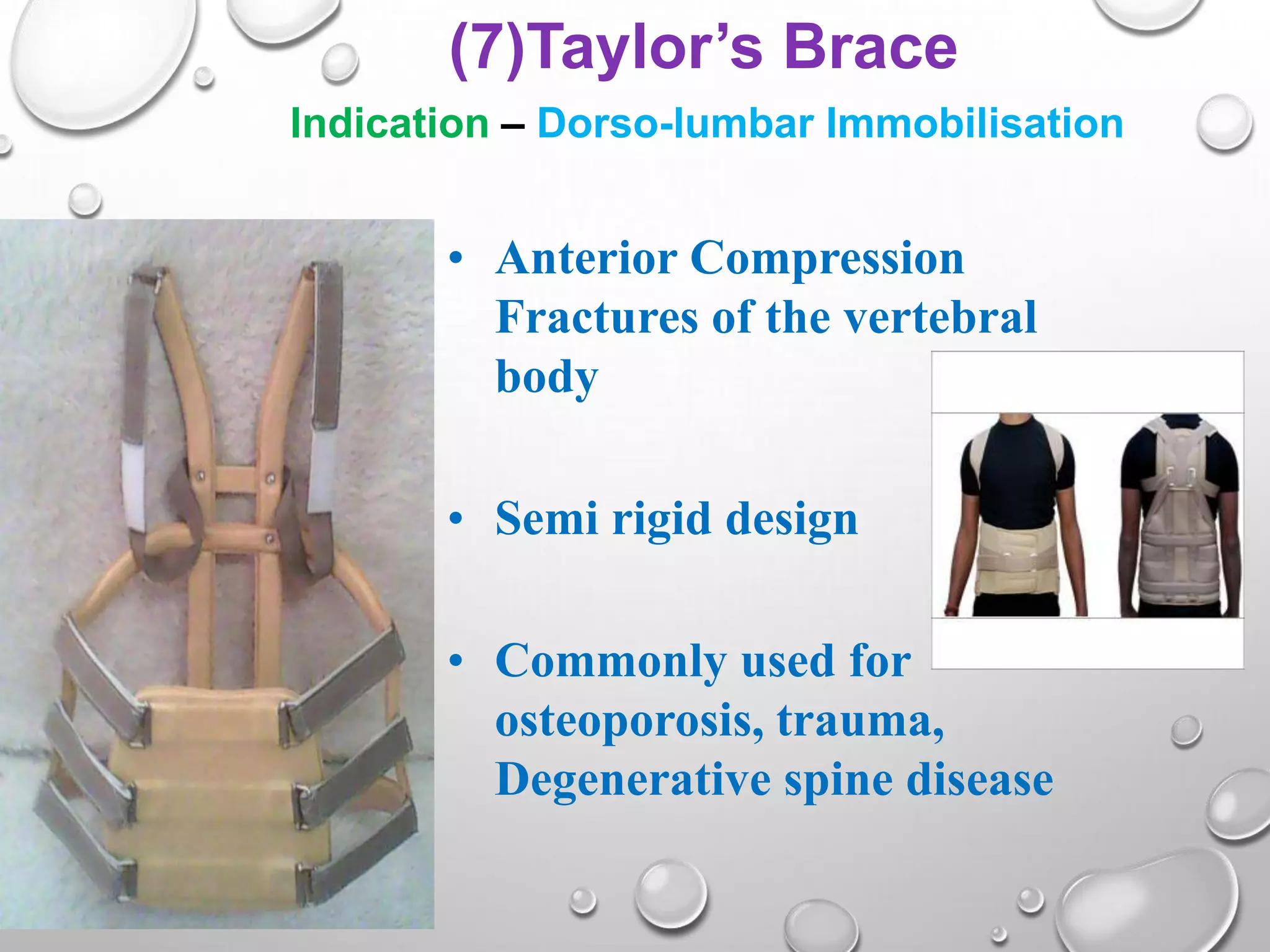 Splint ppt by rupeshkumar | PPTX