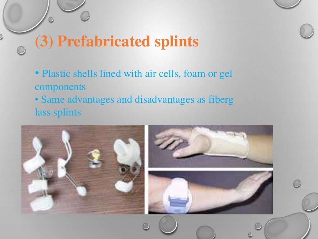 Splint ppt by rupeshkumar