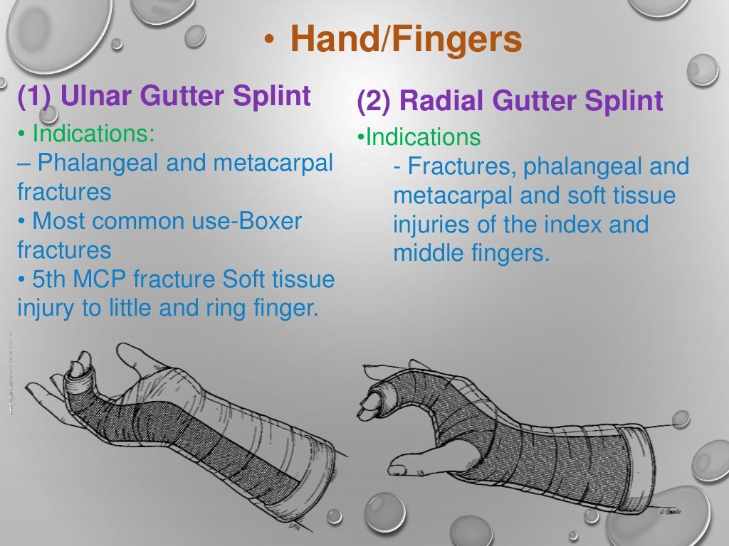 Splint ppt by rupeshkumar