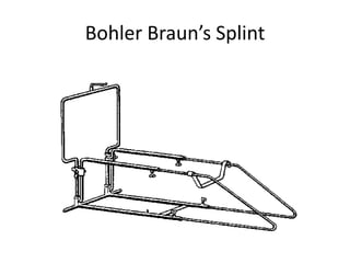 Bohler Braun’s Splint

 
