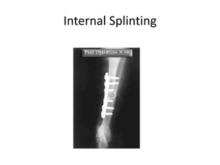 Internal Splinting

 