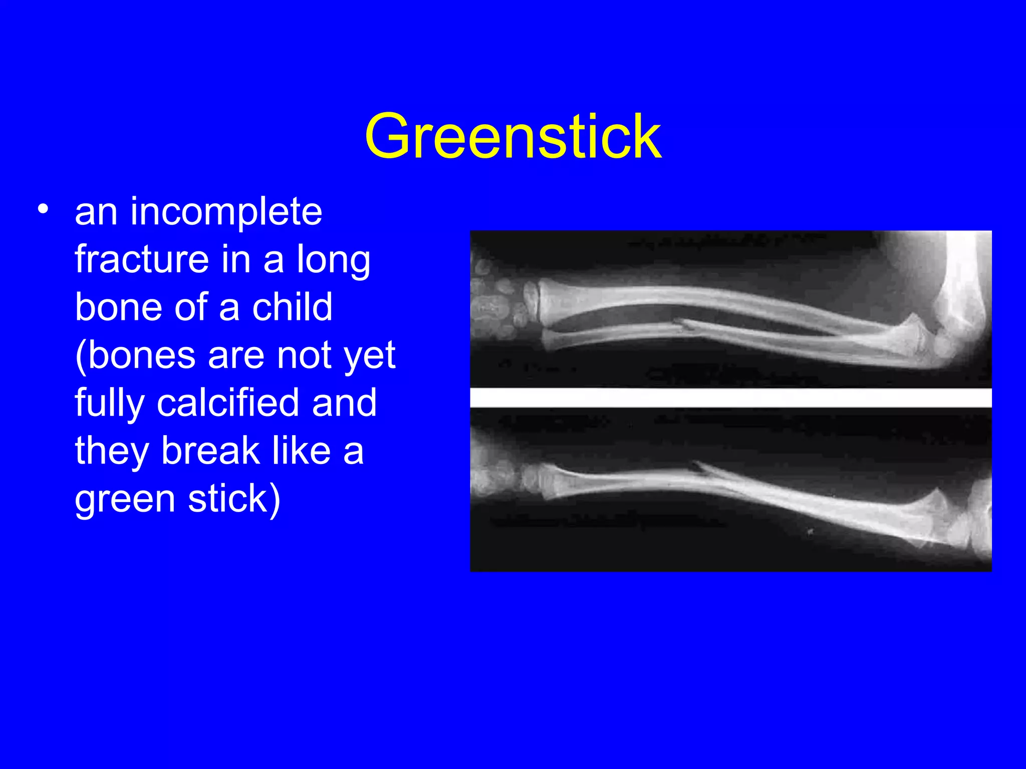 Splints PPT