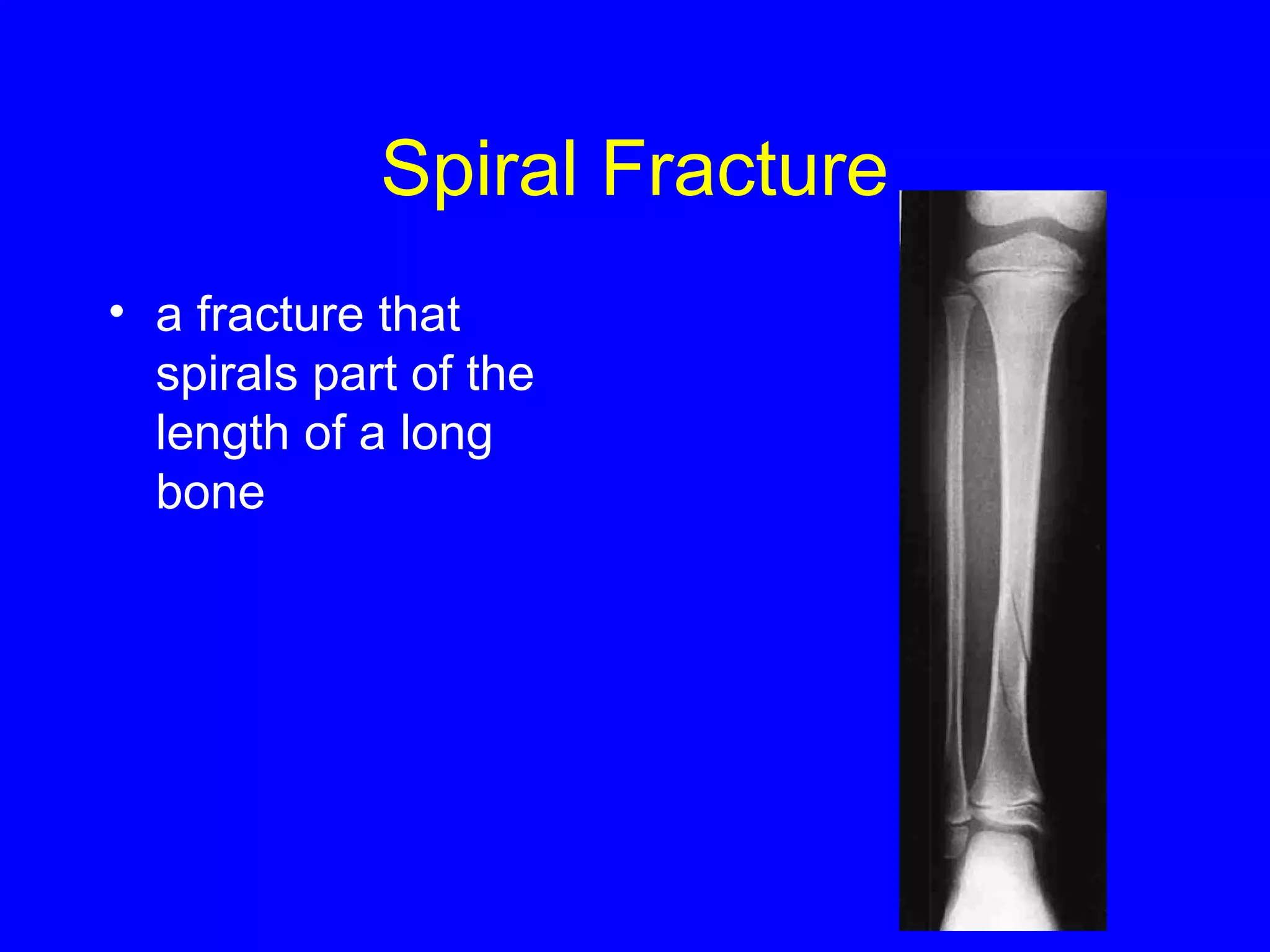 Spiral Fracture 
• a fracture that 
spirals part of the 
length of a long 
bone 
 