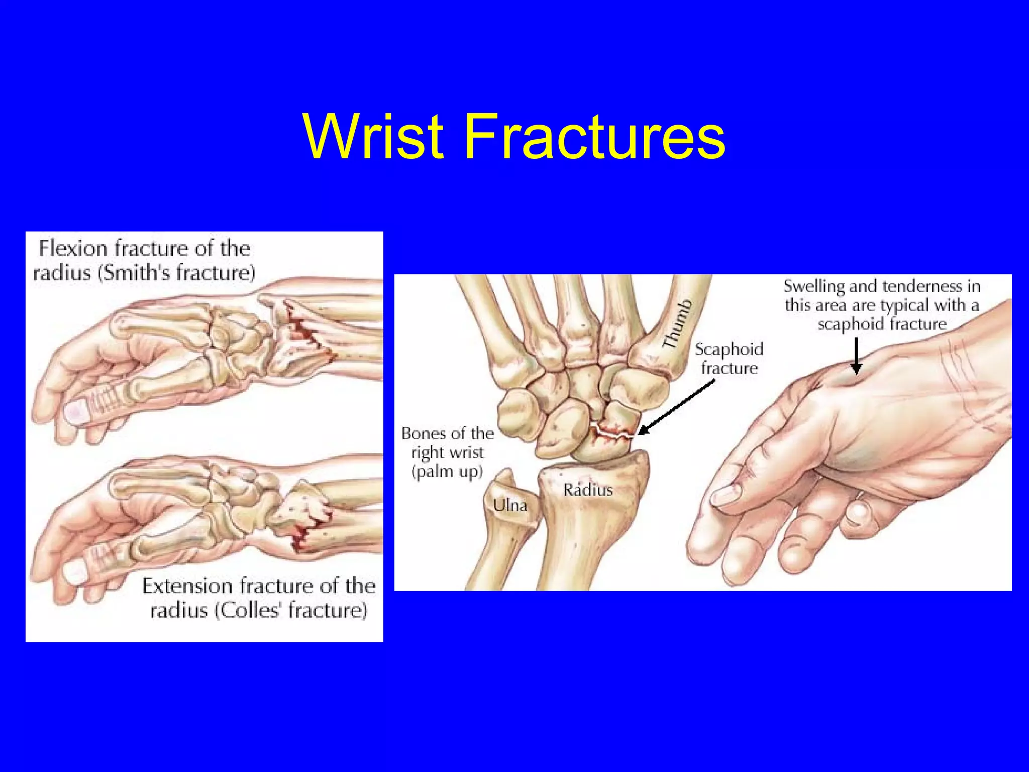 Wrist Fractures 
 