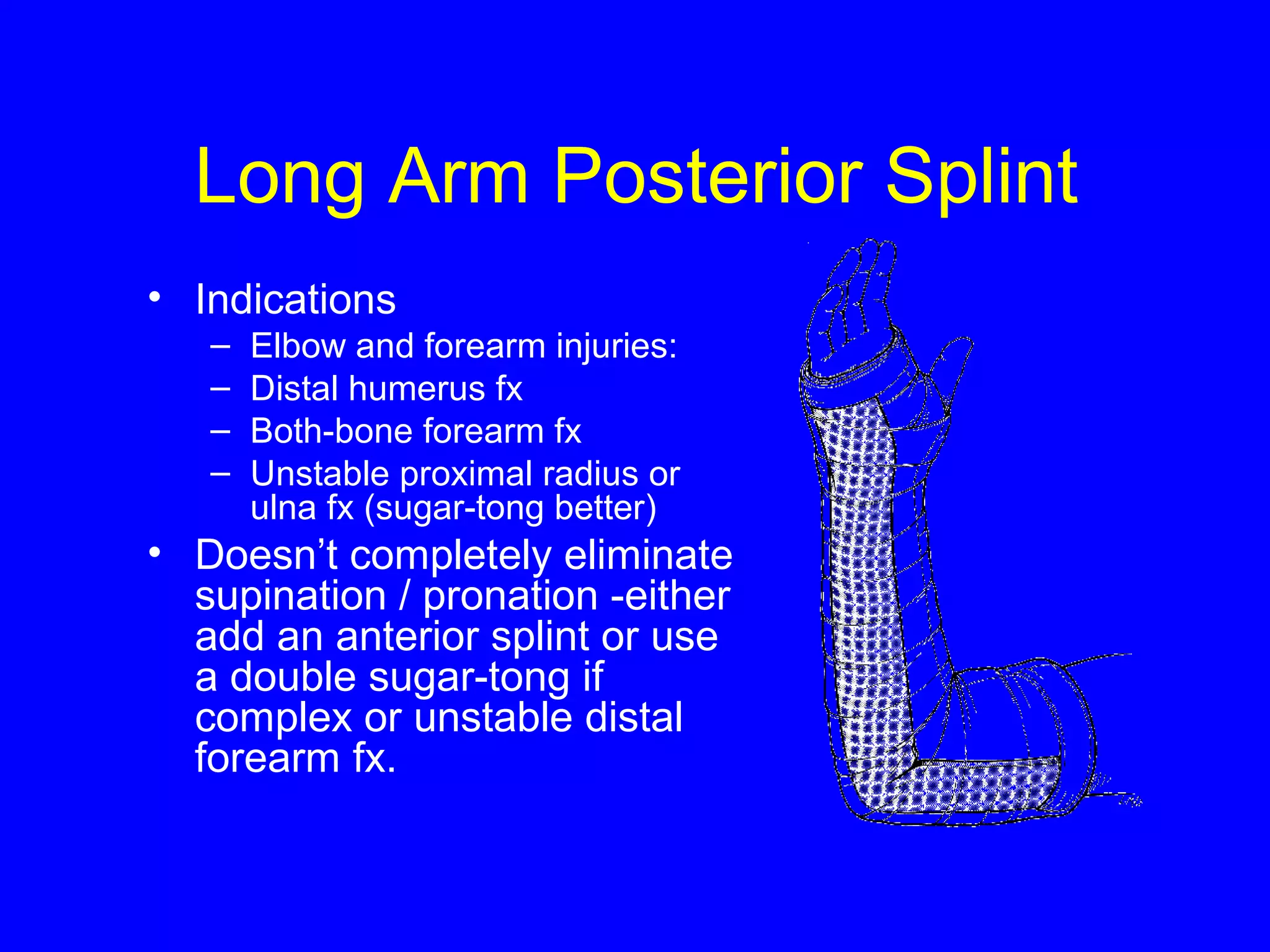 Long Arm Posterior Splint 
• Indications 
– Elbow and forearm injuries: 
– Distal humerus fx 
– Both-bone forearm fx 
– Unstable proximal radius or 
ulna fx (sugar-tong better) 
• Doesn’t completely eliminate 
supination / pronation -either 
add an anterior splint or use 
a double sugar-tong if 
complex or unstable distal 
forearm fx. 
 
