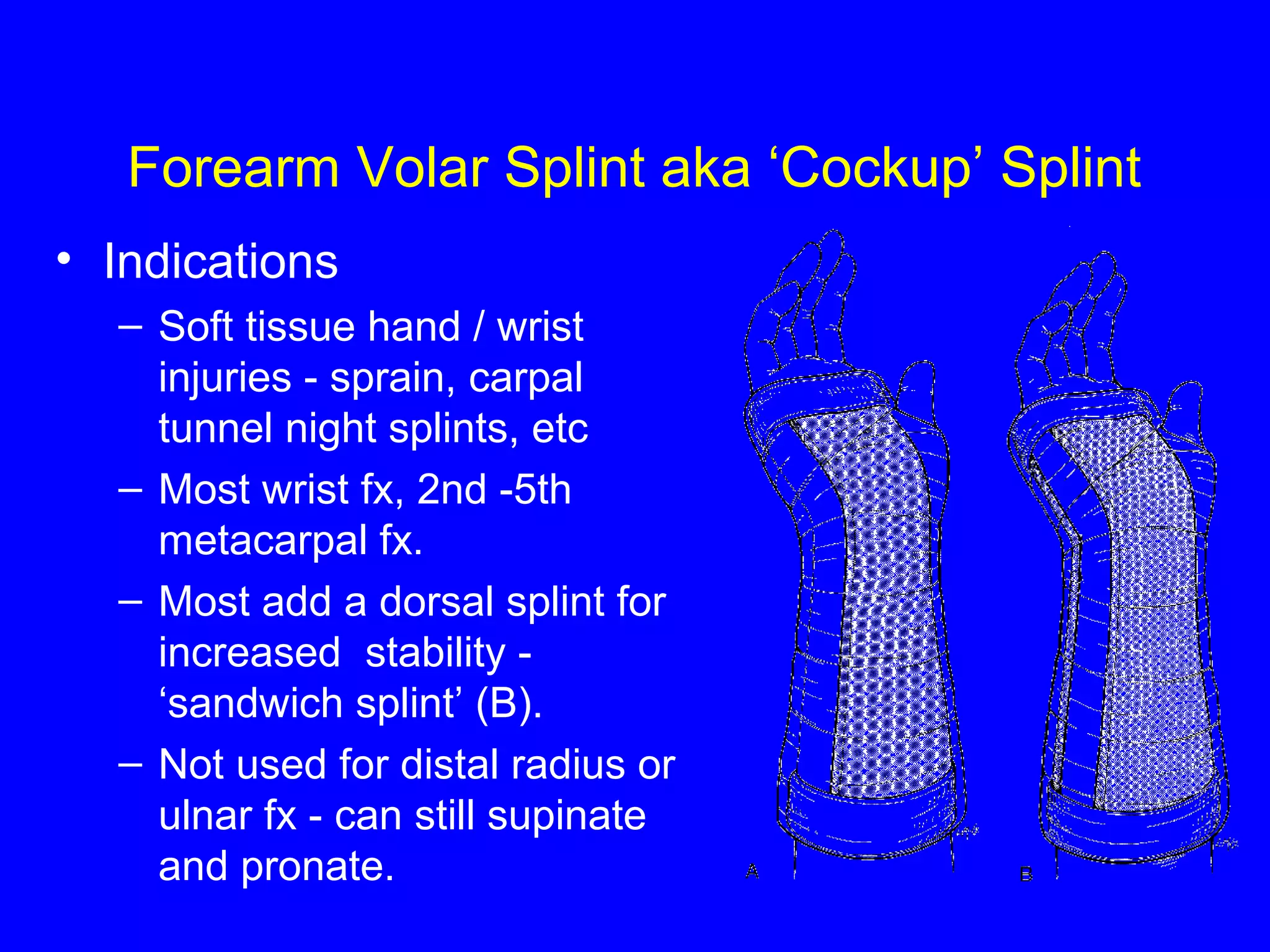 Forearm Volar Splint aka ‘Cockup’ Splint 
• Indications 
– Soft tissue hand / wrist 
injuries - sprain, carpal 
tunnel night splints, etc 
– Most wrist fx, 2nd -5th 
metacarpal fx. 
– Most add a dorsal splint for 
increased stability - 
‘sandwich splint’ (B). 
– Not used for distal radius or 
ulnar fx - can still supinate 
and pronate. 
 