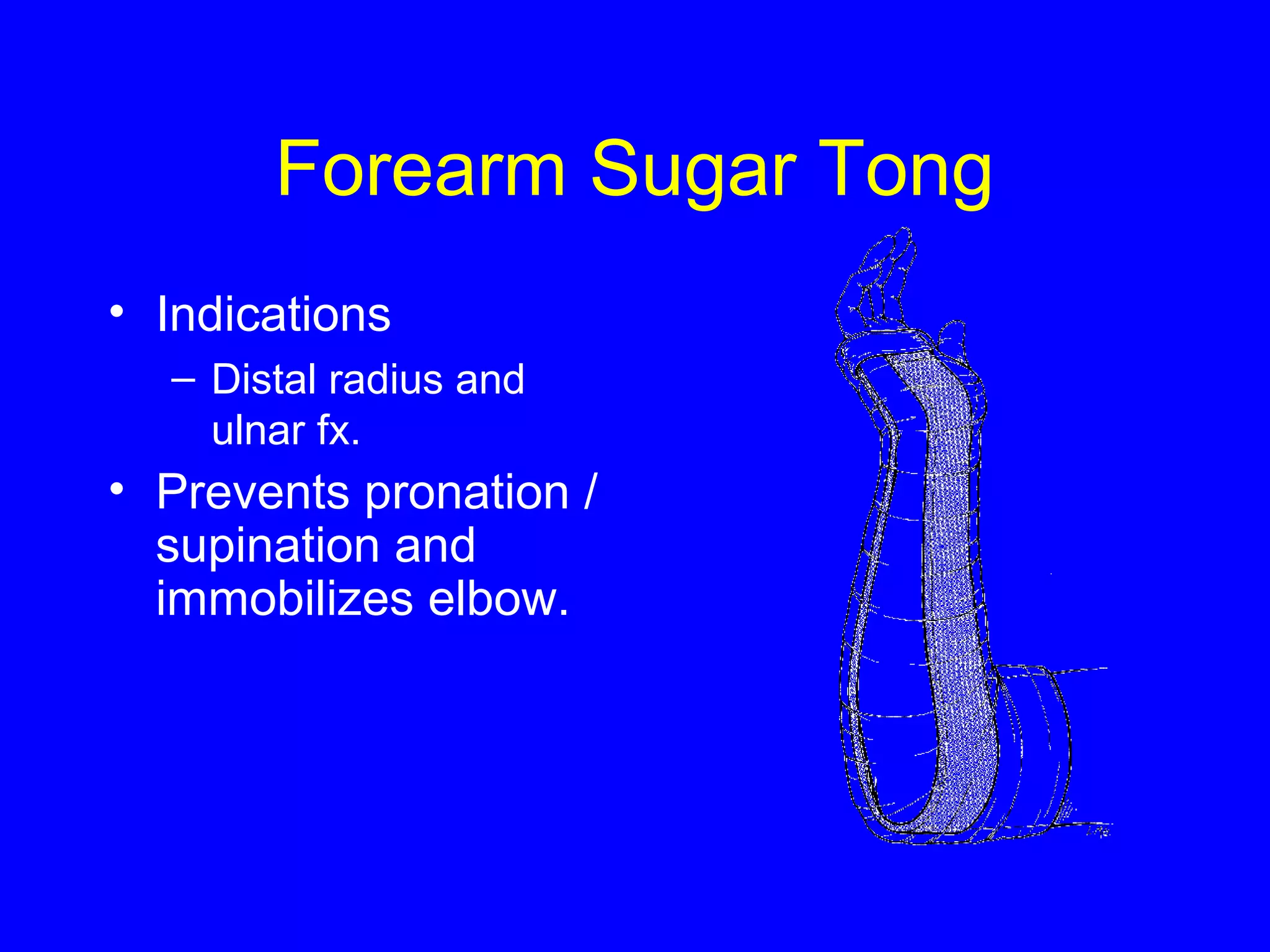 Forearm Sugar Tong 
• Indications 
– Distal radius and 
ulnar fx. 
• Prevents pronation / 
supination and 
immobilizes elbow. 
 