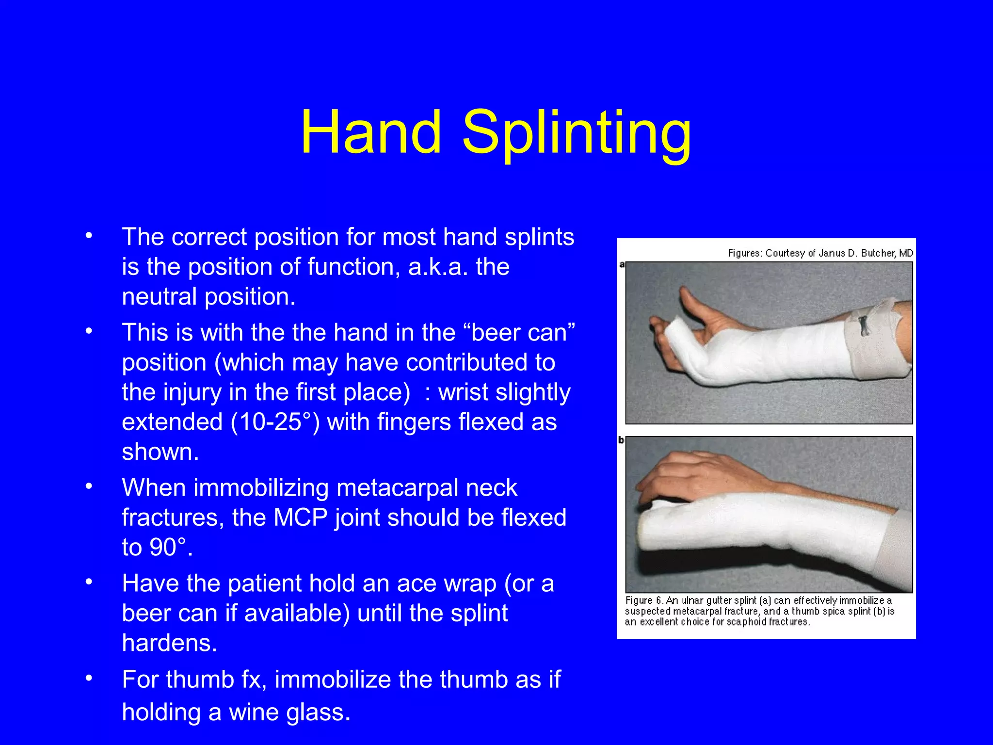 Hand Splinting 
• The correct position for most hand splints 
is the position of function, a.k.a. the 
neutral position. 
• This is with the the hand in the “beer can” 
position (which may have contributed to 
the injury in the first place) : wrist slightly 
extended (10-25°) with fingers flexed as 
shown. 
• When immobilizing metacarpal neck 
fractures, the MCP joint should be flexed 
to 90°. 
• Have the patient hold an ace wrap (or a 
beer can if available) until the splint 
hardens. 
• For thumb fx, immobilize the thumb as if 
holding a wine glass. 
 