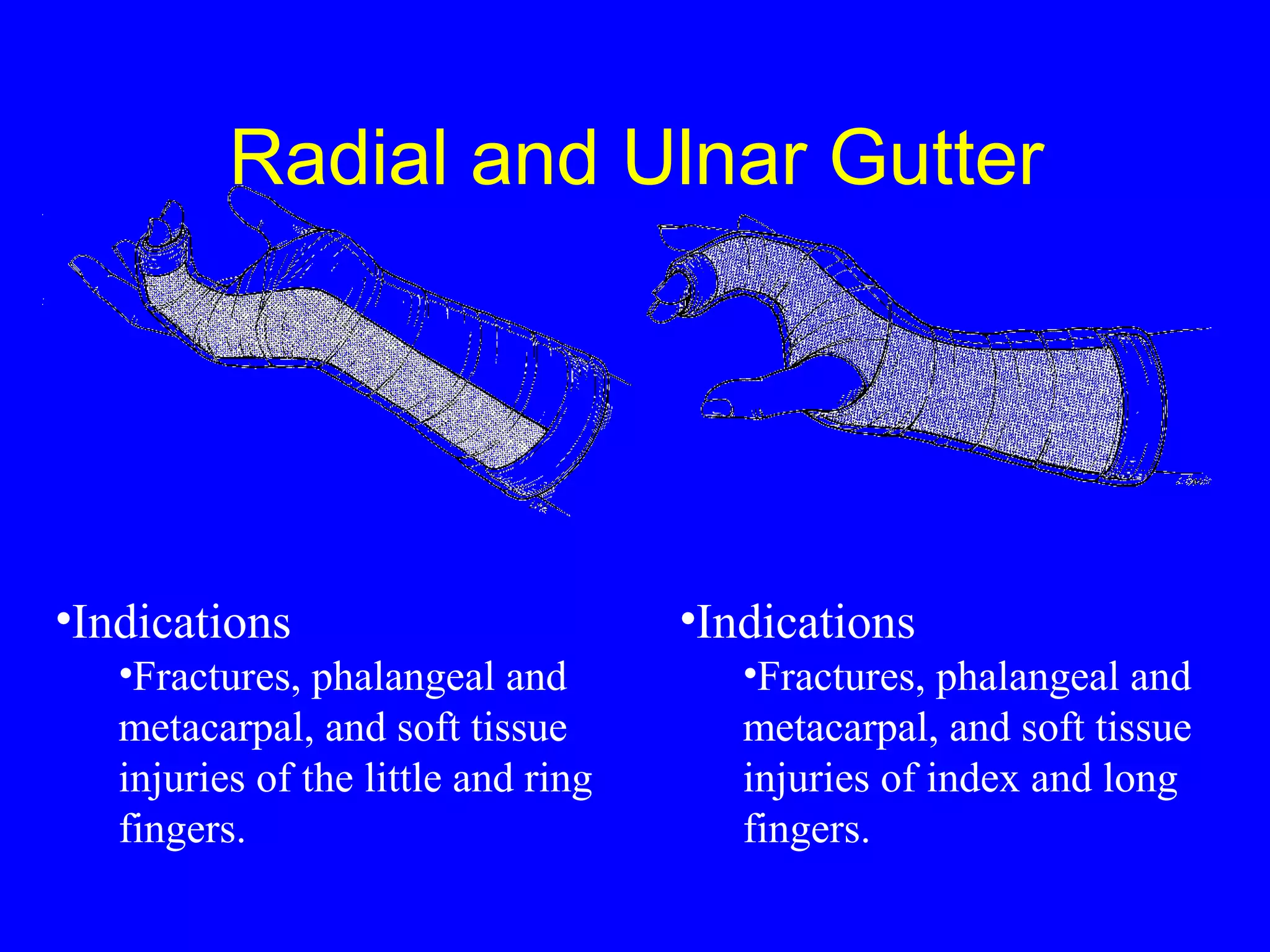 Radial and Ulnar Gutter 
•Indications 
•Fractures, phalangeal and 
metacarpal, and soft tissue 
injuries of the little and ring 
fingers. 
•Indications 
•Fractures, phalangeal and 
metacarpal, and soft tissue 
injuries of index and long 
fingers. 
 