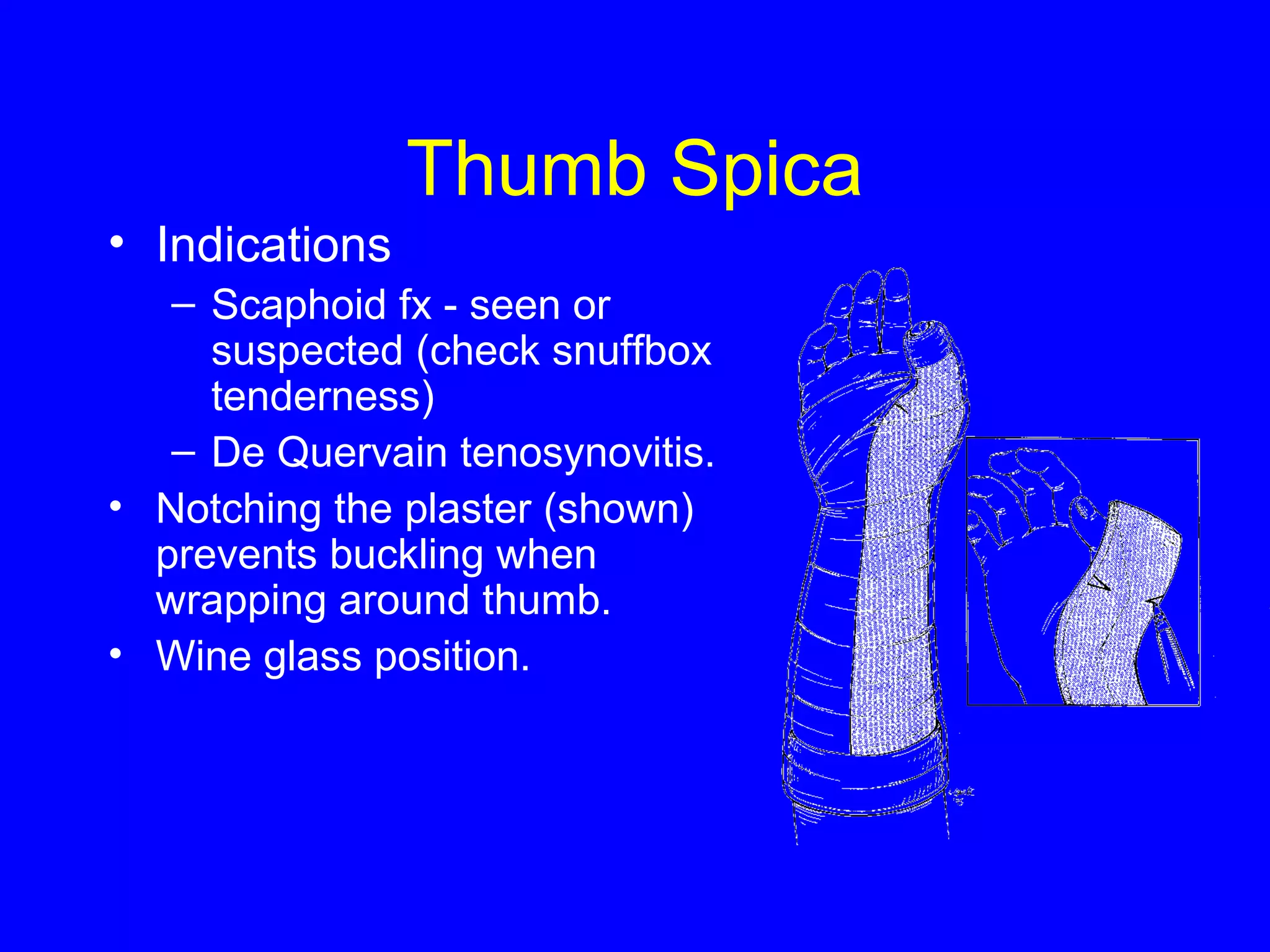 Thumb Spica 
• Indications 
– Scaphoid fx - seen or 
suspected (check snuffbox 
tenderness) 
– De Quervain tenosynovitis. 
• Notching the plaster (shown) 
prevents buckling when 
wrapping around thumb. 
• Wine glass position. 
 