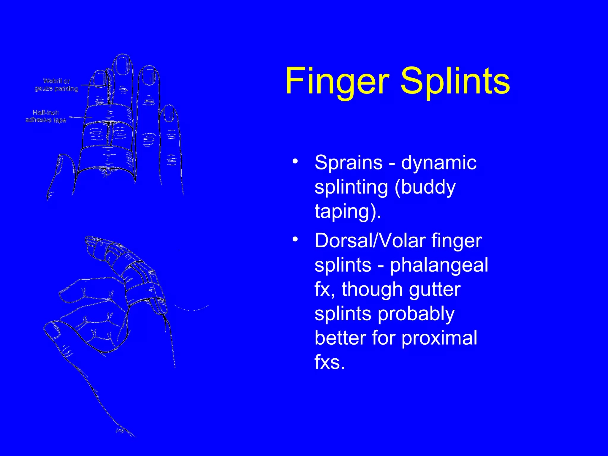 Finger Splints 
• Sprains - dynamic 
splinting (buddy 
taping). 
• Dorsal/Volar finger 
splints - phalangeal 
fx, though gutter 
splints probably 
better for proximal 
fxs. 
 