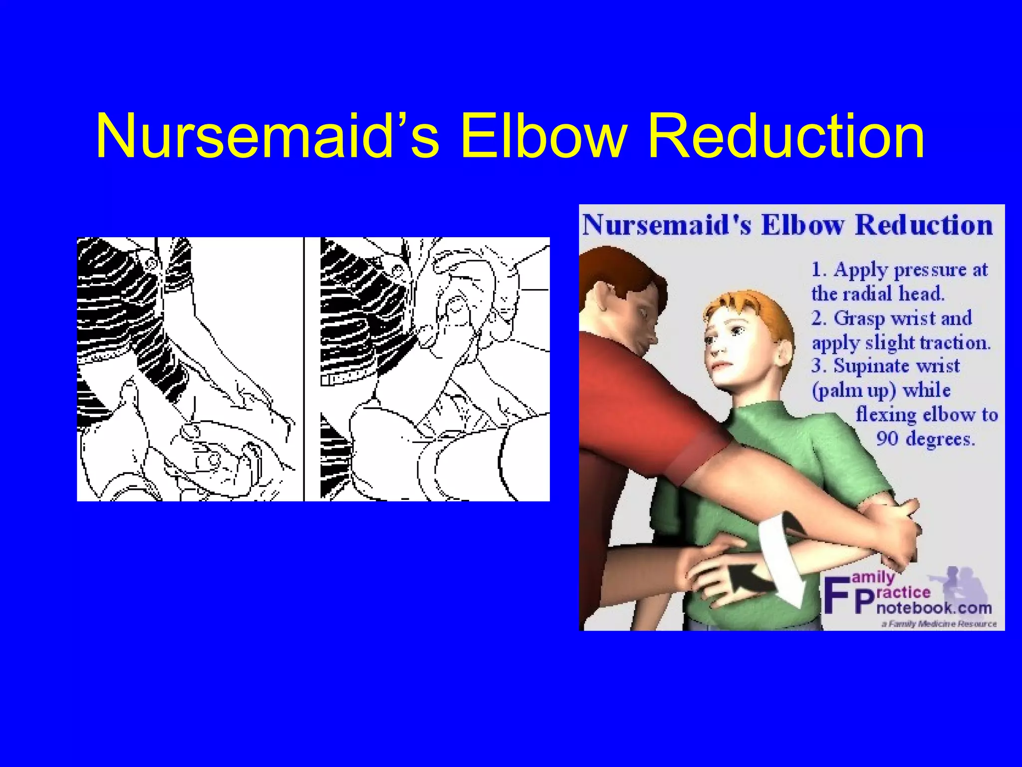 Nursemaid’s Elbow Reduction 
 