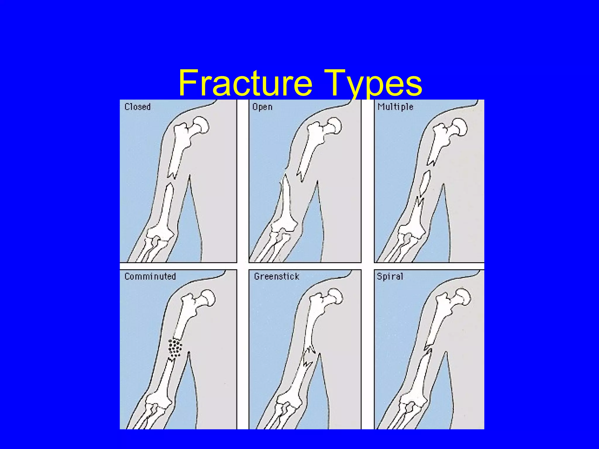 Fracture Types 
 