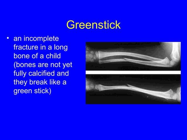 Splints | PPT