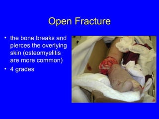 Open Fracture 
• the bone breaks and 
pierces the overlying 
skin (osteomyelitis 
are more common) 
• 4 grades 
 