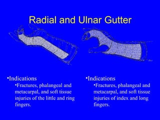 Radial and Ulnar Gutter 
•Indications 
•Fractures, phalangeal and 
metacarpal, and soft tissue 
injuries of the little and ring 
fingers. 
•Indications 
•Fractures, phalangeal and 
metacarpal, and soft tissue 
injuries of index and long 
fingers. 
 